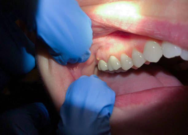 Best Emergency Tooth Extraction in South Fulton, GA